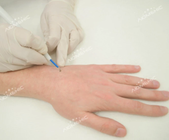 видалення бородавок