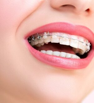Як довго носять брекети і від чого залежить тривалість лікування