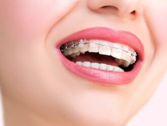 Як довго носять брекети і від чого залежить тривалість лікування
